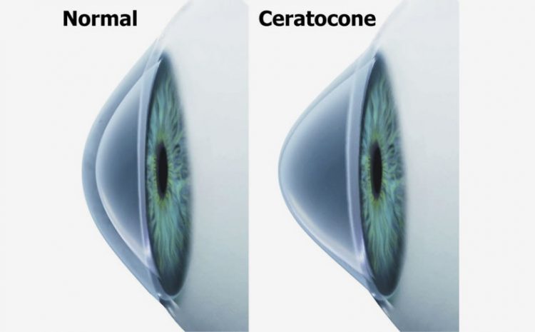  O Ceratocone